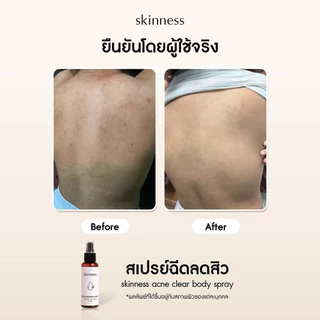[พร้อมส่งทุกวัน] skinness acne clear body spray | สเปรย์ฉีดลดสิวบริเวณผิวกาย