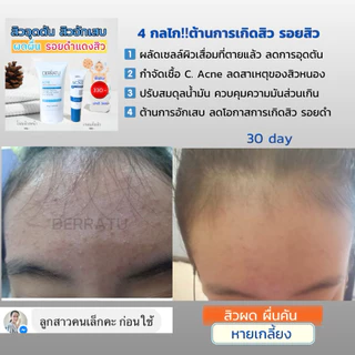 ชุดสิวหายด่วน (โฟม40g + เจลแต้มสิว) DERRATU เคลียร์ทุกสิว สิวอุดตัน สิวอักเสบ สิวยุบไว รอยสิวจางเร็ว หน้าใสไกลสิว