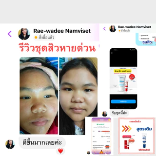 ชุดสิวหายด่วน (โฟม40g + เจลแต้มสิว) DERRATU เคลียร์ทุกสิว สิวอุดตัน สิวอักเสบ สิวยุบไว รอยสิวจางเร็ว หน้าใสไกลสิว