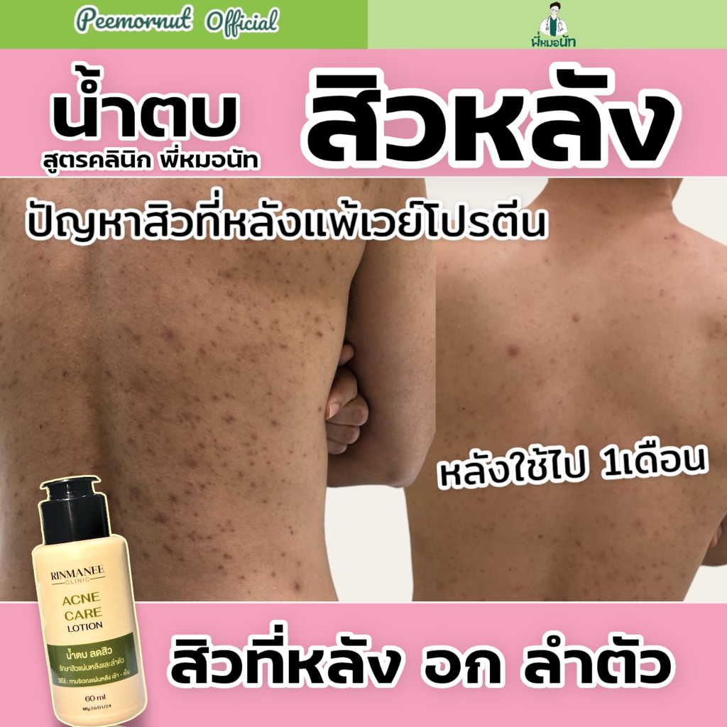 Acne Care lotion น้ำตบลดสิวที่หลัง สิวอก สิวลำตัว ฆ่าเชื้อสิว สิวยีสต์ เชื้อรา สเปรย์สิวที่หลัง ลดรอยดำ สูตรคลินิก