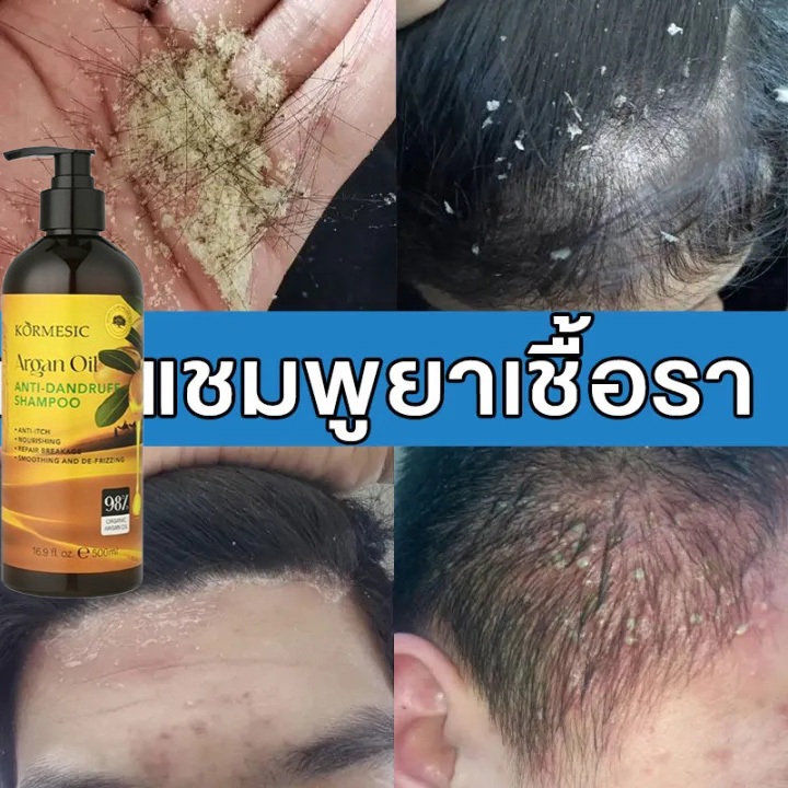 ยาสระผมขจัดรังแค แชมพู รังแค แชมพูแก้คัน 500ml แชมพู ผมมัน ขจัดรังแค ลดคันหัว แก้คัน ลดผมร่วง รักษาเซบเดิร์ม กลากเกลื้อน