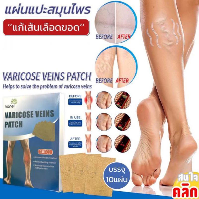 แผ่นแปะเส้นเลือดขอด พร้อมส่ง