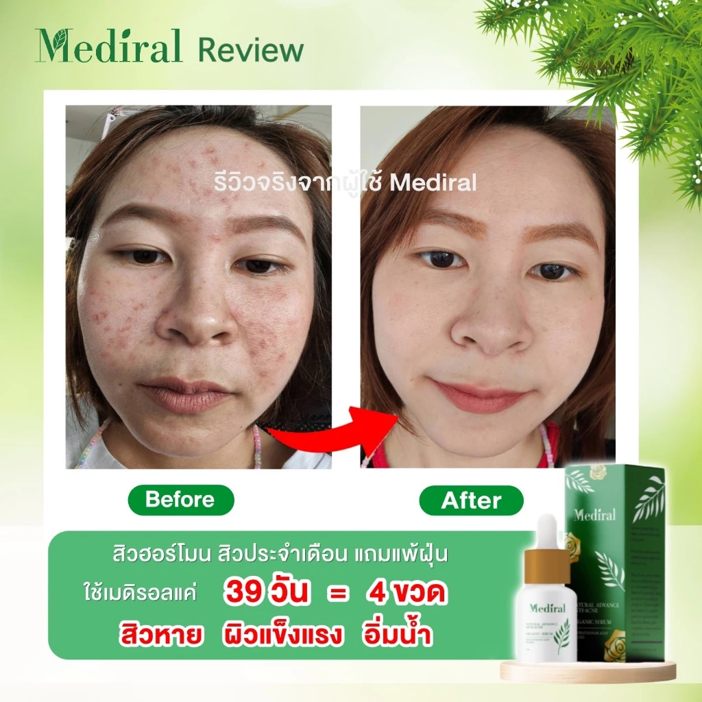 (ส่งฟรี) เซรั่มลดสิว+เซรั่มหน้าใส ลดรอยสิว ฝ้า กระ สกินแคร์ออร์แกนิกใช้คู่กันลดสิวผิวใส thumbnail 8