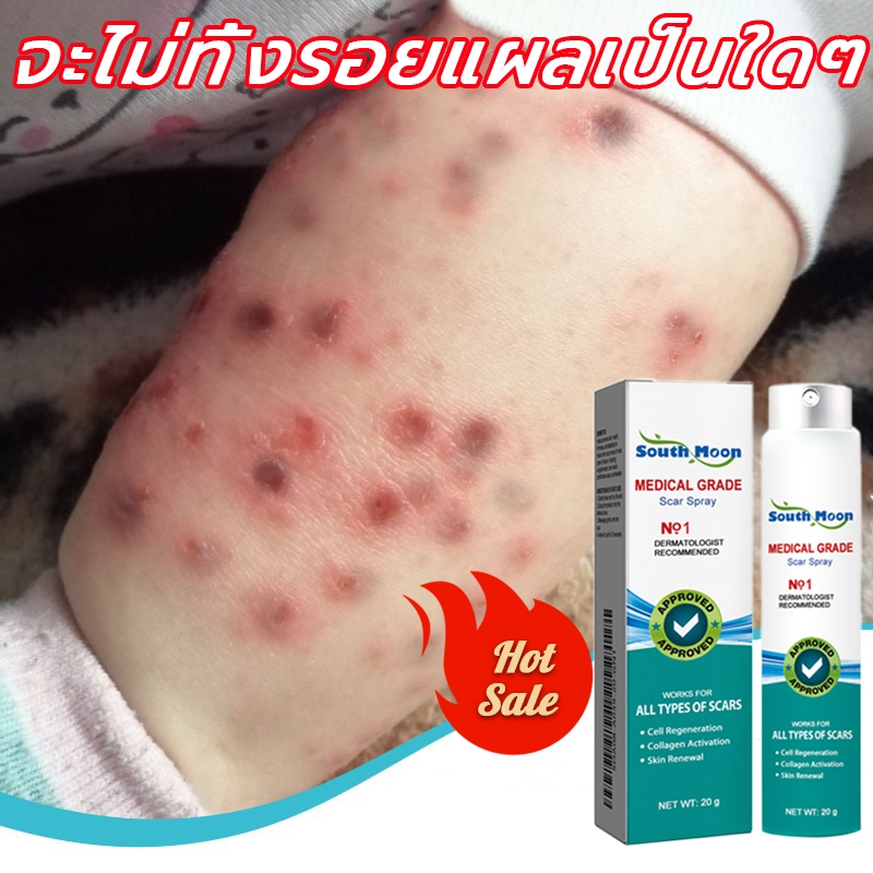 【100%ของแท้】South Moon สเปรย์ลบรอยแผลเป็น 20g เจลลดรอยแผลเป็น ครีมทาแผลเป็น แผลไฟไหม้ รอยสิว รอยแตกล