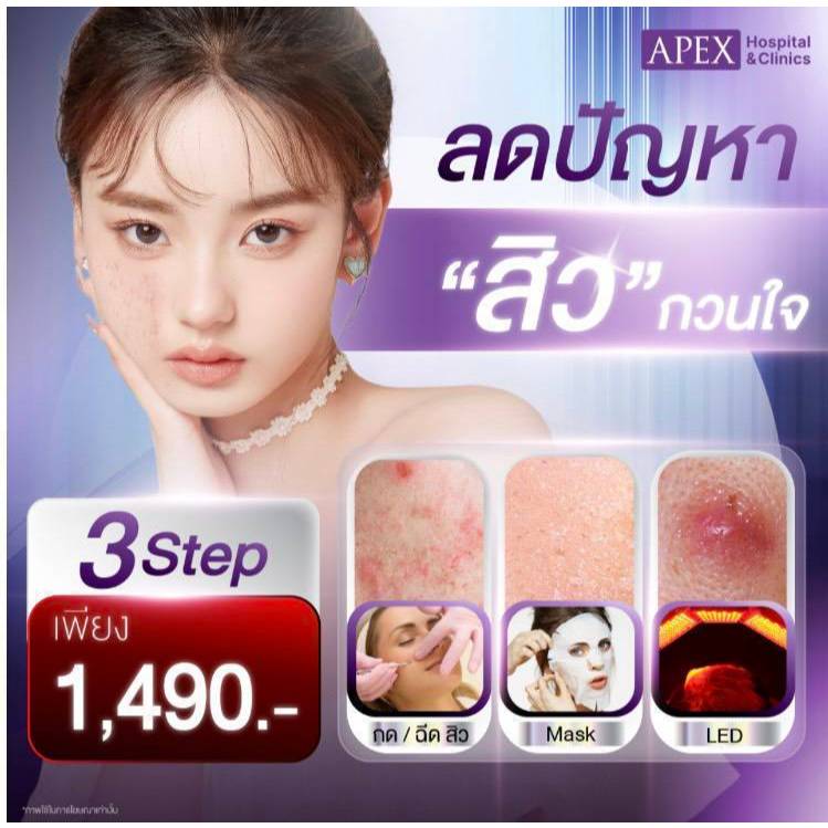 E-Voucher เลเซอร์ Apex โปรแกรมรักษาสิว Acne 2 รักษา สิว 4 ขั้นตอน ลดสิว สิวอักเสบ ลดการระคายเคือง