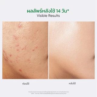 [Facerinna official] Facerinna 2% Salicylic Acne Serum เซรั่มลดสิว ลดสิว ปลอบประโลมผิว รอยดำ น้ําตบ Niacinamide กระจ่าง