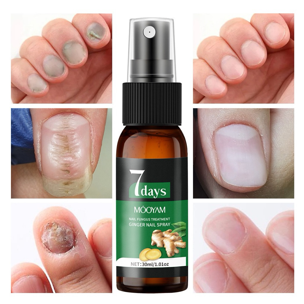 ฟื้นฟูเล็บให้ดูสะอาด สุขภาพดีใน 7 วัน 7 DAYS+ Nail Fungus Treatment สูตรธรรมชาติ อ่อนโยน แต่จัดการเช