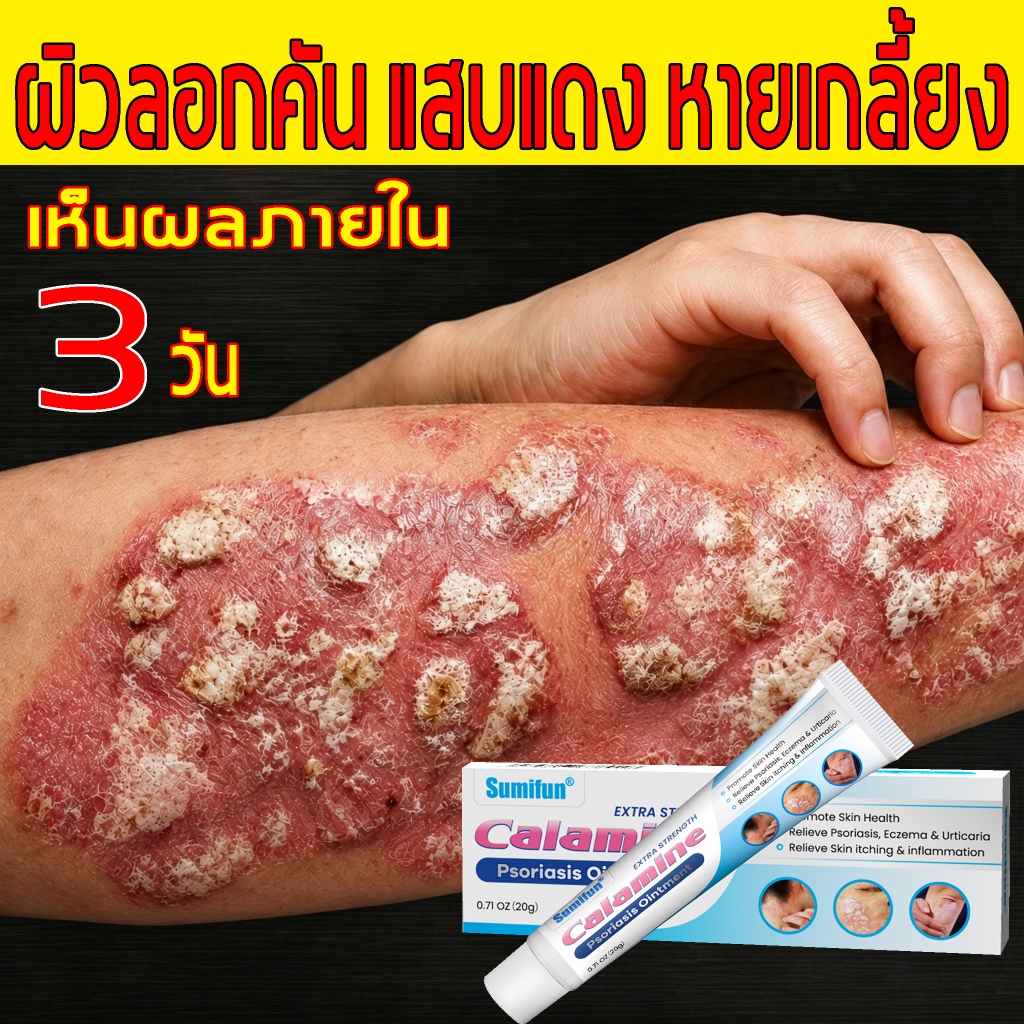 ครีมแก้ผื่นคัน ครีมบำรุงผิวสูตรอ่อนโยน 20g ด้วยสารสกัดจากพืช ให้ความชุ่มชื้น ปลอดภัย เหมาะสำหรับผิวบอบบาง ใช้ง่าย