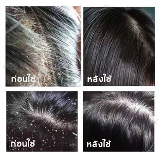 แชมพูซีลีเนียมไดซัลไฟด์ 300ml ขจัดรังแคเชื้อราไรฝุ่น คุมความมัน ดูแลรูขุมขน ผมนุ่มฟูสดชื่นใช้ได้ทุกเพศ