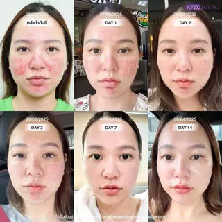 [E-Voucher] APEX โปรแกรม Pico New Gen ราย1ครั้ง ลดรอยสิว รอยแดง รอยดำ หลุมสิวหาย หน้าใส สำหรับลูกค้าใหม่ / ไม่เคยทำพิโค่