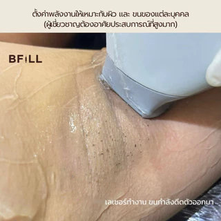 BFiLL โปรแกรม Diode Laser กำจัดขน 1 ครั้ง Size XS, S, M ขนหนวด,เครา ลดขนขึ้นไว, ตอขนชัด, ขนคุด เลเซอร์ขนบีฟิล