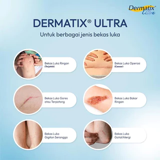 [แท้100% ส่งจากไทย] Dermatix Ultra Gel เดอร์มาติกซ์ อัลตร้า เจลลดรอยแผลเป็น ขนาด 15 กรัม ลดรอยสิว รอยผ่าตัด ผิวเนียนเรีย