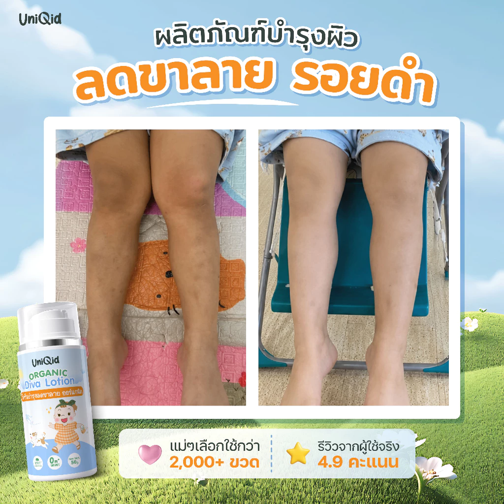 โลชั่นบำรุง ลดขาลาย ออร์แกนิค ยูนิคิด สำหรับเด็ก อ่อนโยน ปลอดภัย 100%