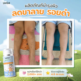 โลชั่นบำรุง ลดขาลาย ออร์แกนิค ยูนิคิด สำหรับเด็ก อ่อนโยน ปลอดภัย 100%