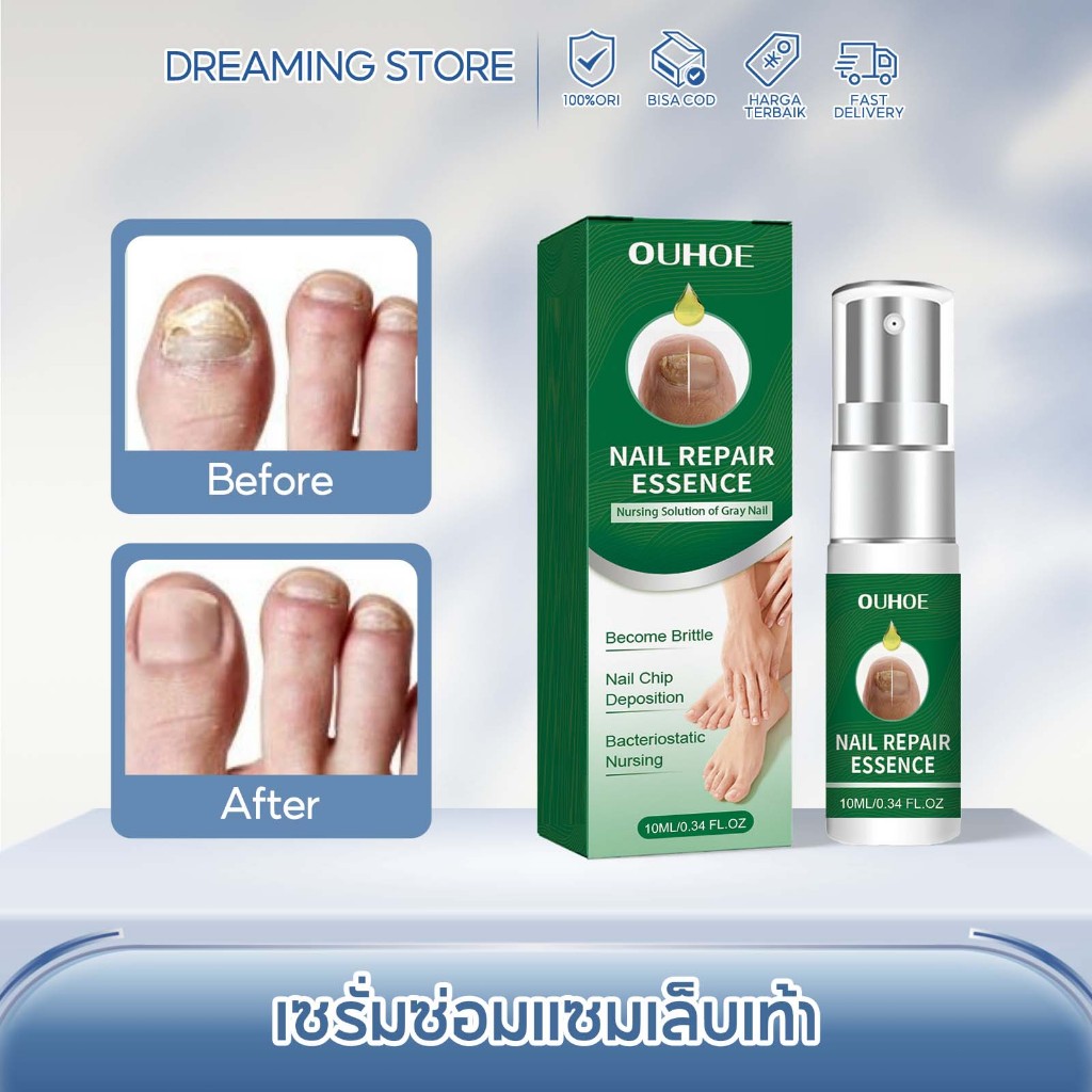 OUHOE เซรั่มเล็บ เชื้อราเล็บมือ ห่างกับปัญหาเล็บ เซรั่มเชื้อราเล็บ น้ำยาเล็บขบ ไม่ทำร้ายเล็บ เชื้อราที่เล็บ ยาทาเชื้อราท