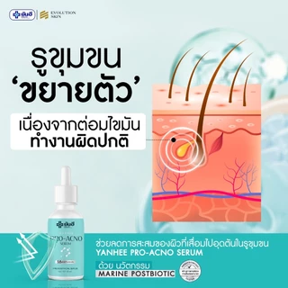 Yanhee Pro Acno Serum ยันฮี โปรแอกโน่ เซรั่ม ลดสิว ผิวมัน สิวผด สิวไม่มีหัว สิวฮอร์โมน
