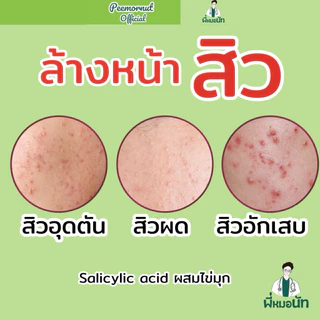Acne Pearl เจล ล้างลดสิว pH5.5 Salicylic เหมาะคนเป็นสิว คุมมัน สิวอุดตัน สิวอักเสบ สิวผด ลดสิว สิวหาย