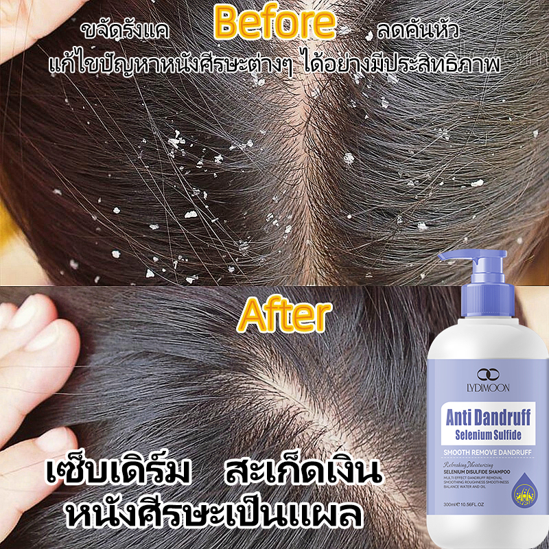 ແຊມພູກຳຈັດຮັງແຄ LYDIMOON 300ML - ບັນທຸກອາການຄັນ, ເຊບໂຣຣິກເດີມາທາດ, ແລະ ຜົມຫາຍ