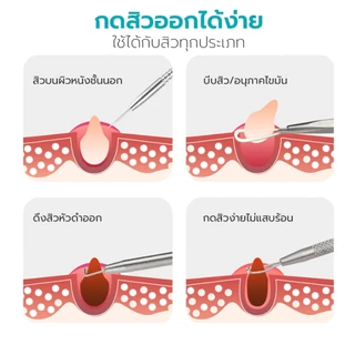 Hanaso ที่กดสิว อุปกรณ์กดสิว เข็มกดสิว 4 ชิ้น Acne tool ช่วยกำจัดสิวหัวดำ สิวเสี้ยน และสิวอุดตันได้อย่างมีประสิทธิภาพ