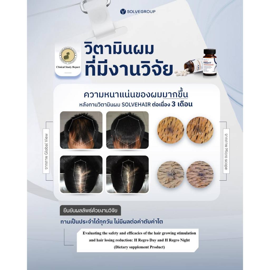 เซตลดผมร่วง ผมบาง เพิ่มการงอกใหม่ของเส้นผม Solve Hair Full Set - รูปที่ 5