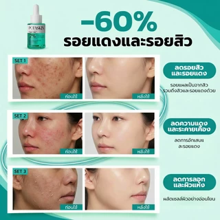POPASKIN 2% BHA+MA Anti-Acne Serum เซรั่มลดสิว ลดรอยสิว คุมมัน ลดสิวอุดตัน ลดการอักเส 30ML