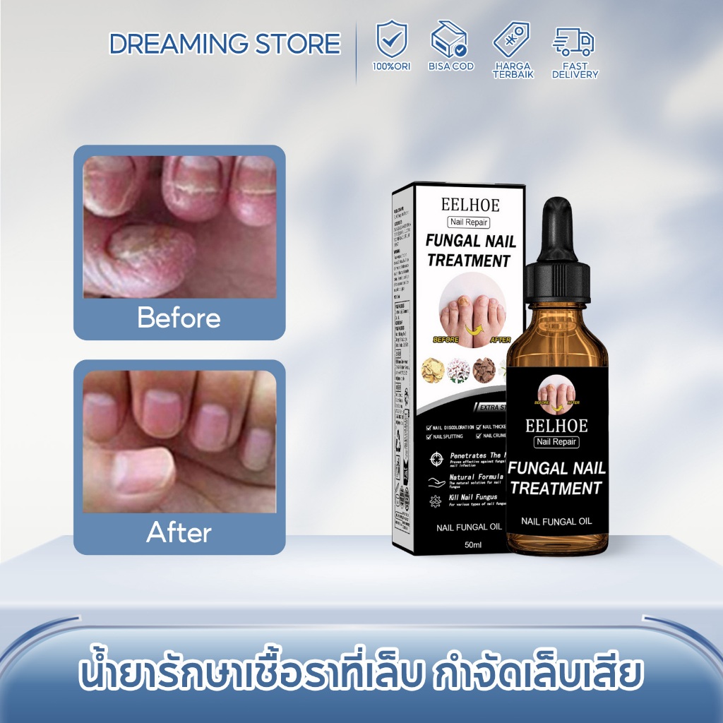 EELHOE น้ำยารักษาเชื้อราที่เล็บ กำจัดเล็บเสีย ซ่อมแซมเล็บแตก น้ำยาซ่อมแซมเล็บเหลือง ดูแลเล็บ น้ำยารักษาเ น้ำยารักษาเล็บ