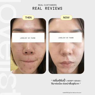 Lovelist เซรั่มเฮิร์บปี้ ฮีลผิวสิวสงบ Herbpy Secret Serum