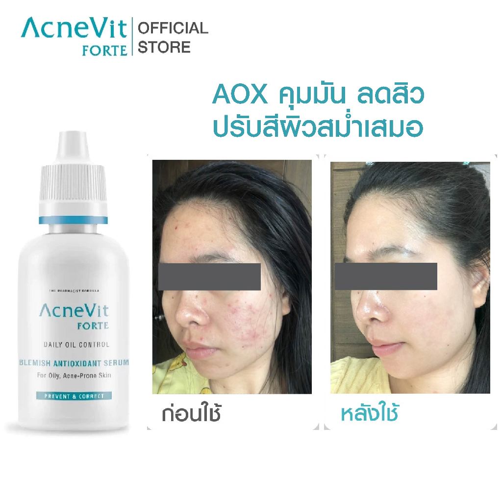 Acnevit Forte Blemish Antioxidant Serum 30ml (เซรั่ม AOXเพื่อคนผิวมัน เป็นสิวง่ายโดยเฉพาะ)