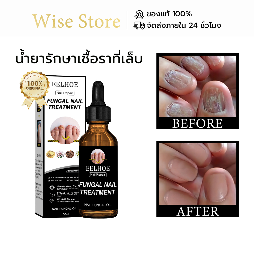 EELHOE น้ำยารักษาเชื้อราที่เล็บ น้ำยาซ่อมแซมเล็บเหลือง น้ำยารักษาเล็บ กำจัดเล็บเสีย ซ่อมแซมเล็บแตก ดูแลเล็บ nail repair