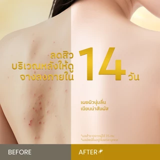 Grace and Glow English Pear and Freesia Acne Solution Body Wash ครีมอาบน้ำลดสิว 400ml