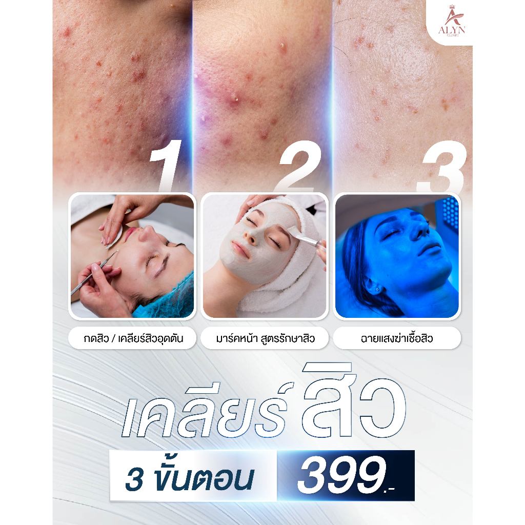 โปรแกรมเคลียร์สิว ALYN Clinic 3 ขั้นตอน กดสิว + มาร์คหน้าลดสิว + ฉายแสง