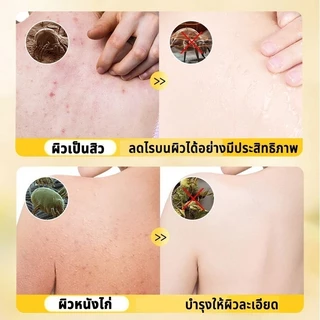 ครีมอาบน้ำลดสิว กำจัดไรเจลอาบน้ํา 500ml ต่อต้านเชื้อราแก้คัน ให้ความชุ่มชื้นอ่อนโยน กลิ่นหอมติดทน ลดสิว กำจัดไร คุมน้