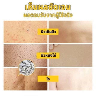 ครีมอาบน้ำลดสิว กำจัดไรเจลอาบน้ํา 500ml ต่อต้านเชื้อราแก้คัน ให้ความชุ่มชื้นอ่อนโยน กลิ่นหอมติดทน ลดสิว กำจัดไร คุมน้