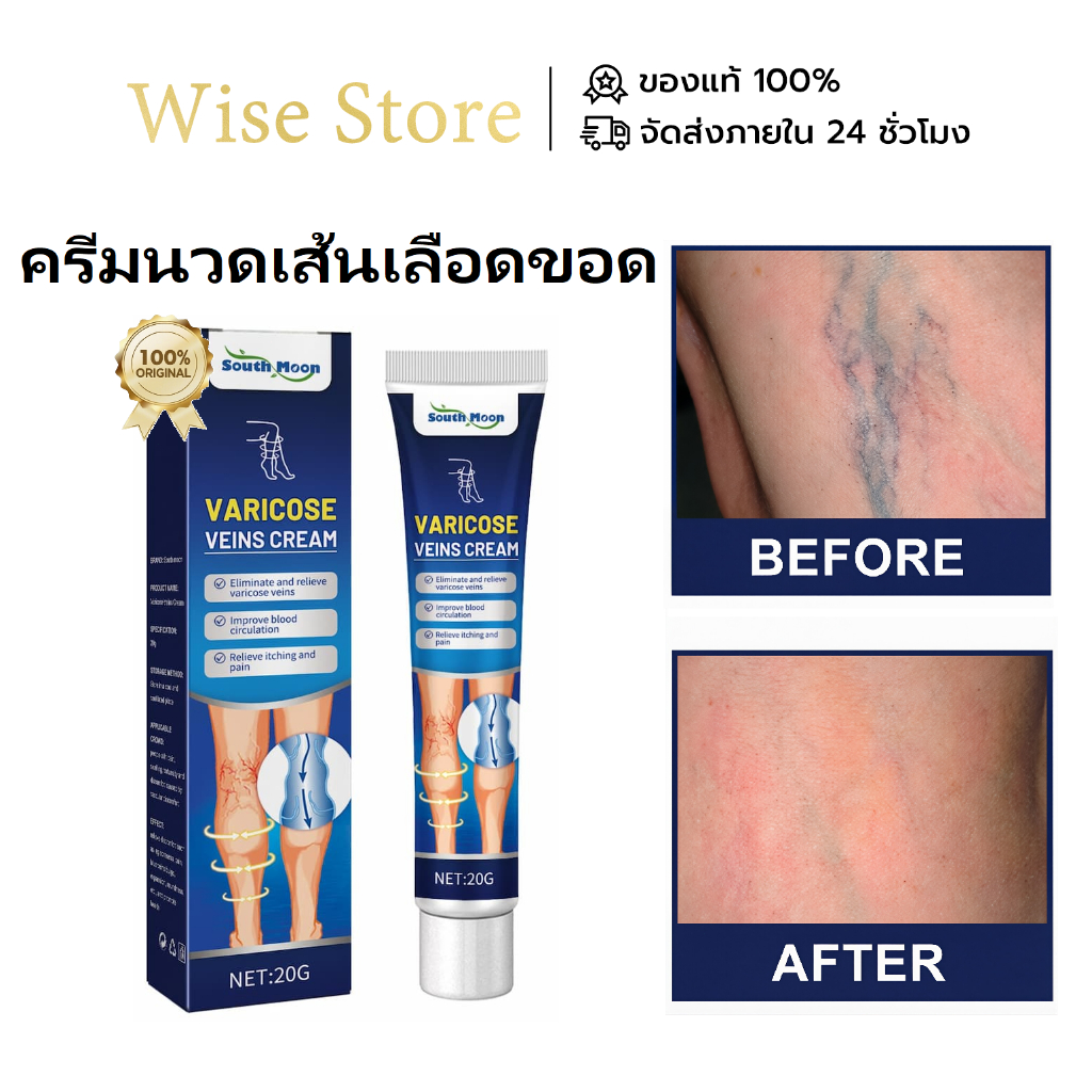 South Moon ครีมเส้นเลือดขอด บรรเทาอาการปวดและเมื่อยล้า ปรับปรุงการไหลเวียนเลือด ลดรอยนูนของเส้นเลือด ใช้ภายนอก 20g