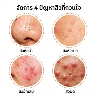 Azelaic Acid 20% Cream Blackhead Acne Scar Removal Sensitive Skin Hydrating Repair Gel