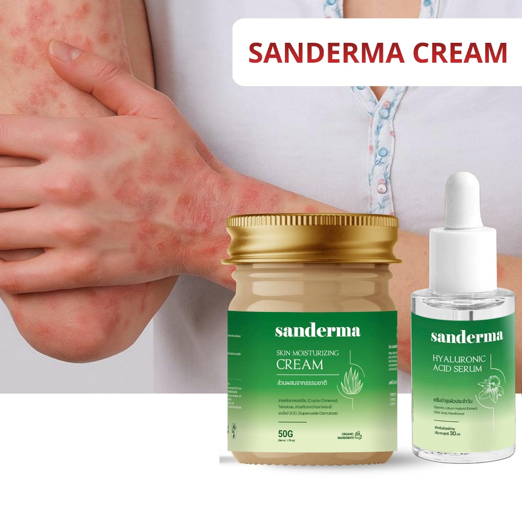 SET SANDERMA CREAM และ SERUM - ลดผื่น คัน กลากเกลื้อน สะเก็ดเงิน ผิวแพ้ง่าย