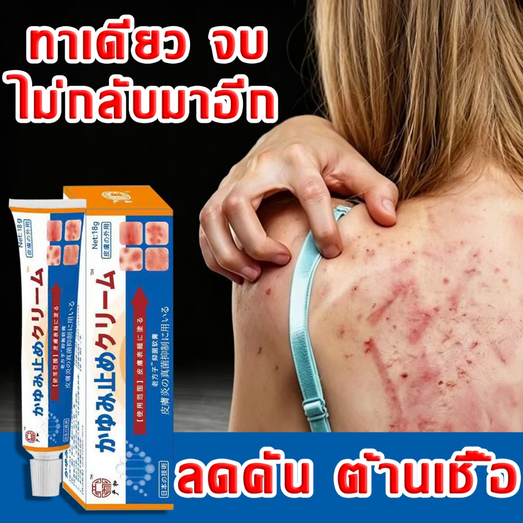 หมดกังวลเรื่องผิวคัน อาการคันผิวหนัง ครีมดูแลผิว ใช้ง่าย ลดความไม่สบายผิว