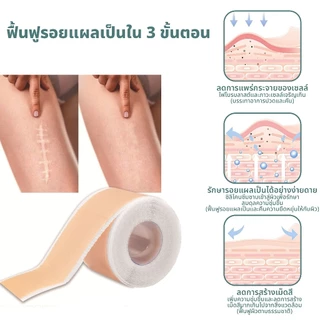 South Moon รักษารอยแผลเป็น แผ่นแปะแผลเป็น กําจัดรอยแผลเป็นจากแผลเป็น เผยผิวเนียนสวย