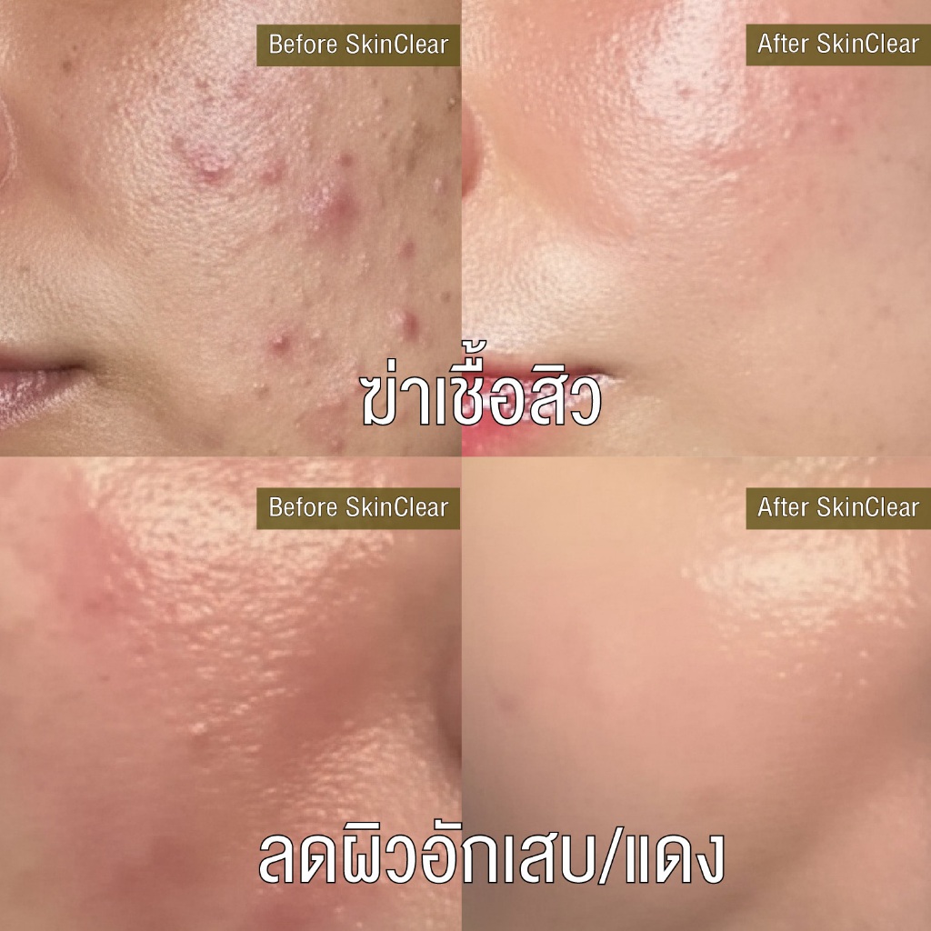 LEAF&PETAL SkinClear Facial Spray สเปรย์ฆ่าเชื้อสิวด้วยสารไฮโปรคลอรัส(HOCl) อ่อนโยน ไม่อุดตัน ไม่ดันสิว ลดการระคายเคือง รูปที่ 4
