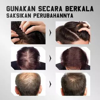 สเปรย์ปลูกผมดูแลหนังศีรษะ สเปรย์ผมจากธรรมชาติ 100%​ ส่งเสริมการเจริญเติบโตของผมดำ เซรั่มสำหรับผมดำ