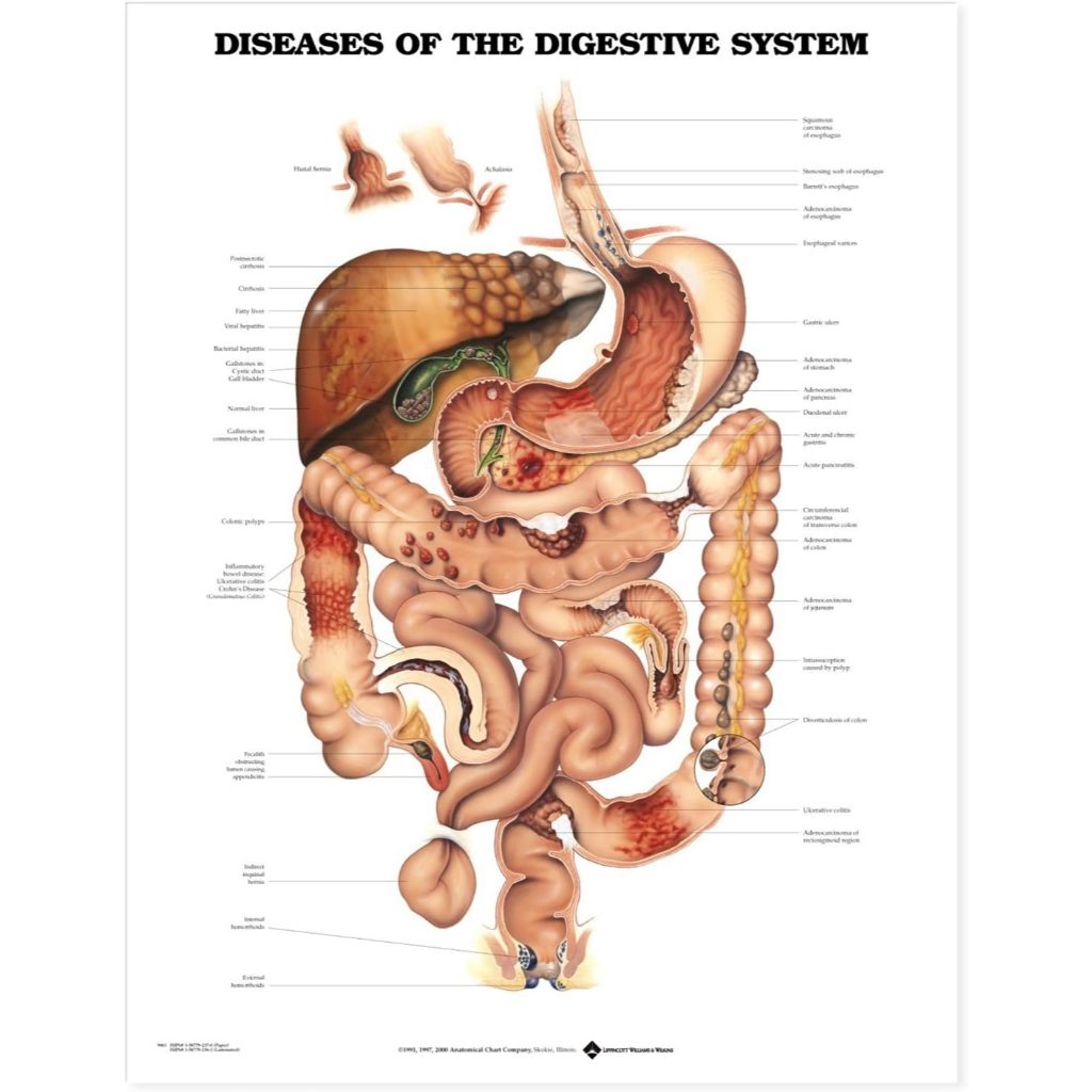 แผ่นโปสเตอร์ Diseases of the Digestive System Anatomical Chart (Paper) ed 1/2000