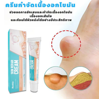 🔥TH ขายร้อน🔥 ครีมกำจัดก้อนไขมันและซีสต์ 30 กรัม อนมันแข็ง เนื้องอกไขมัน สมุนไพรกำจัด ก้อนเนื้อใต้