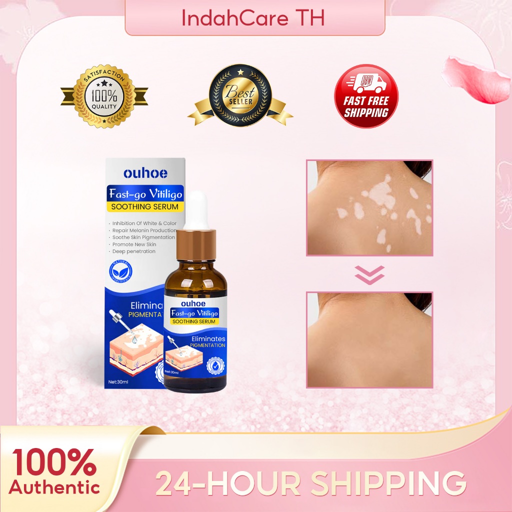 OUHOE เซรั่มบำรุงผิวกาย ลดเลือนด่างขาว เซรั่มทาผิว ลดจุดขาว ทำให้สีผิวเท่ากัน เจลด่างขาว ลดจุดสี 30ml