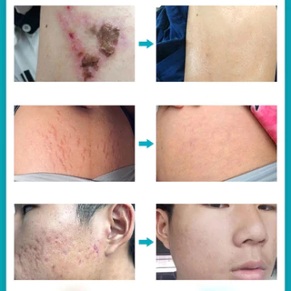 [ของแท้ 100%] ALIVER ครีมลดรอยแผลเป็น แผลเป็นนูนหนา แผลเป็นถลอก เร่งการซ่อมแซมให้ผิว ครีมแผลเป็น ลดแผลเป็น ยาทาแผลเป็น
