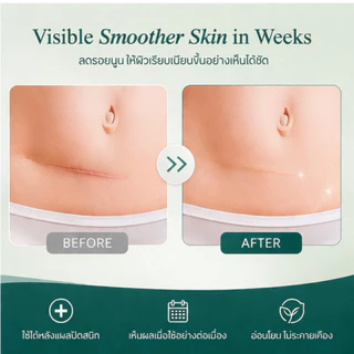 แผ่นแปะลดรอยแผลเป็นนูนแปะแผลผ่าคลอดแผ่นแปะซิลิโคน Silicone scar sheetsสินค้าได้รับการรับรองมาตราฐานจากนวัตกรรม IRELAND