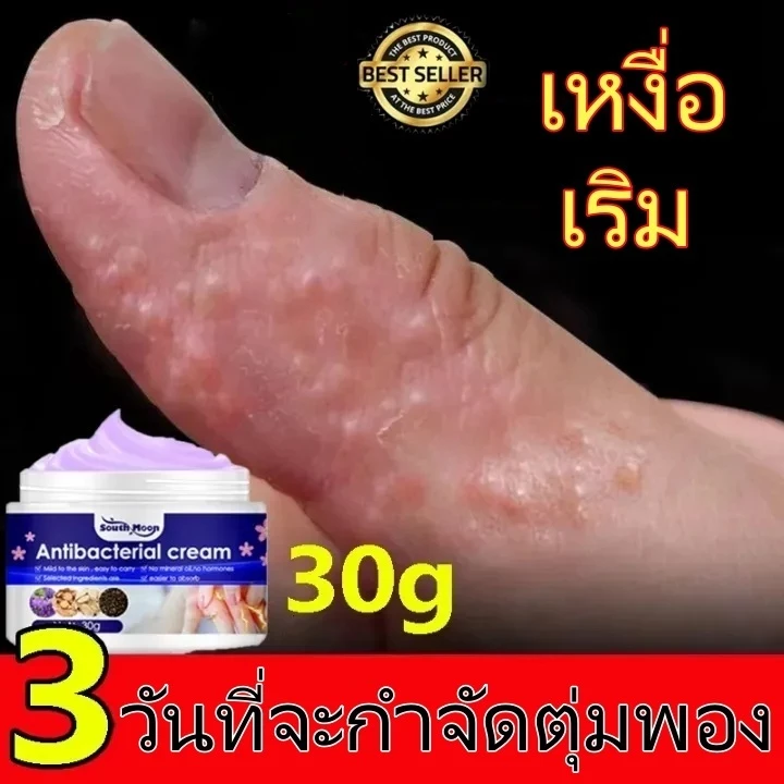 🔥แก้คัฆ่าเชื้อ🔥ครีแก้คัน คันเรื้อง เชื้อรา คันใมผ้า ขาหนีบ เชื้อรา ผื่นกัด Anti-itch cream