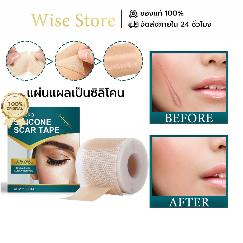 Laniska แผ่นแผลเป็นซิลิโคน แผ่นแปะแผลเป็น Silicone Scar ลดรอยแผลเป็น รักษารอยแผลเป็น กําจัดรอยแผลเป็นจากแผลเ