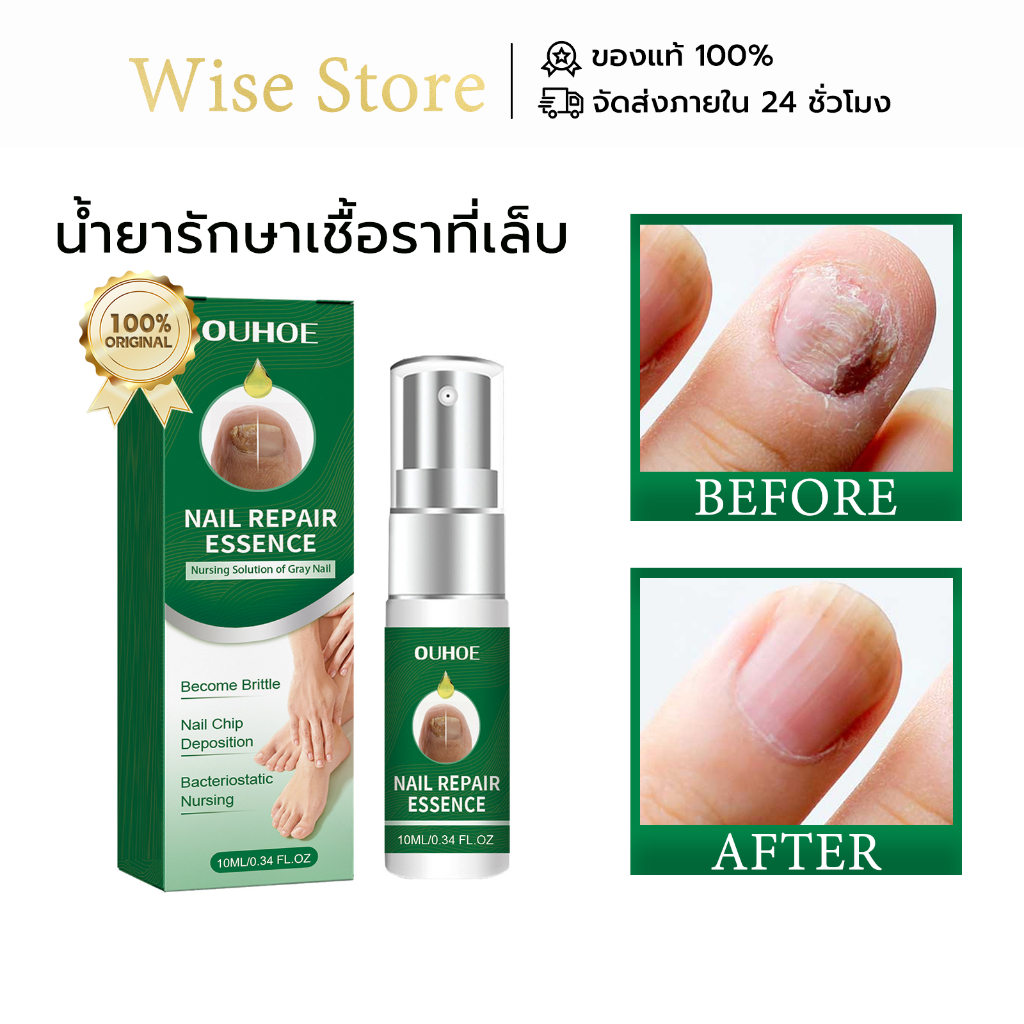OUHOE เซรั่มฟื้นฟูเล็บ รักษาเชื้อราเล็บ เชื้อราที่เล็บ รักษาเล็บ ฆ่าเชื้อราที่เล็บ Nail Repair Serum