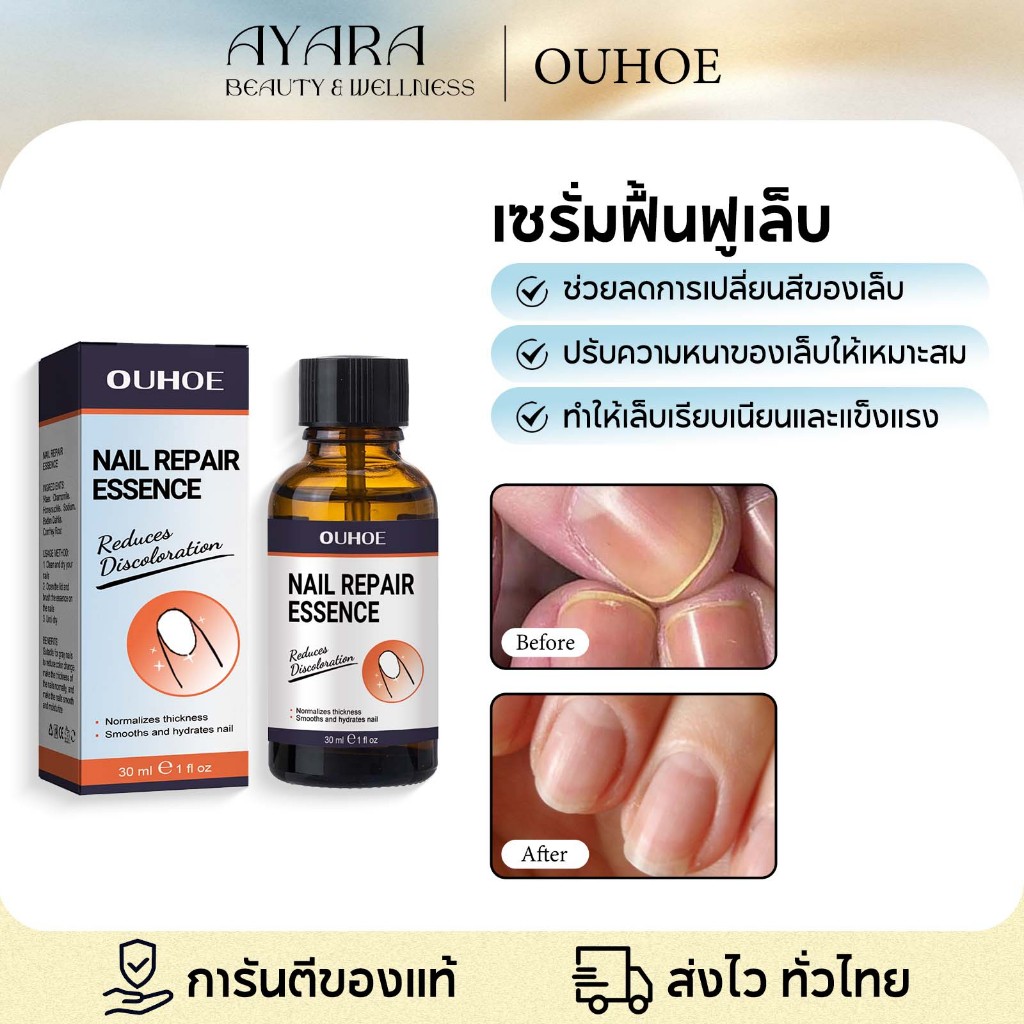 OUHOE น้ำยาฟื้นฟูเล็บ น้ำยารักษาเชื้อราที่เล็บ กำจัดเล็บเสีย เชื้อราเล็บ รักษาเล็บขบ ฆ่าเชื้อราเล็บ