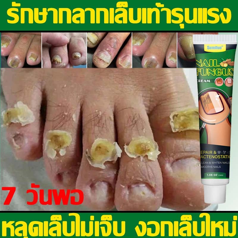 การรักษาเชื้อราที่เล็บ ต้านแบคทีเรีย การป้องกันการติดเชื้อราที่จำเป็น กำจัดเชื้อราที่เล็บ เล็บมือ เล็บเท้า เซรั่มซ่อมแซม